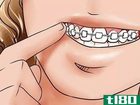 Image titled Apply Dental Wax on Braces Step 4