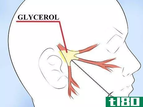 Image titled Alleviate Pain Caused by Trigeminal Neuralgia Step 9