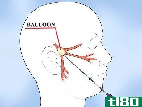 Image titled Alleviate Pain Caused by Trigeminal Neuralgia Step 8