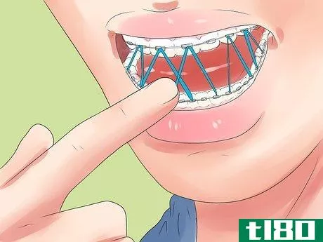 Image titled Alleviate Orthodontic Brace Pain Step 11
