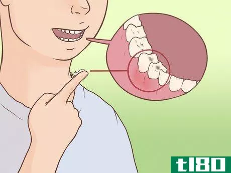 Image titled Alleviate Toothache Pain Step 2