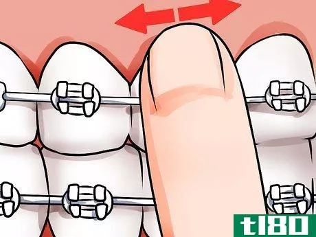 Image titled Apply Dental Wax on Braces Step 8