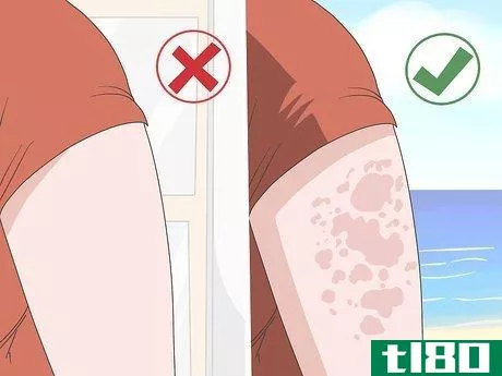 Image titled Avoid Triggers for Chronic Hives Step 4