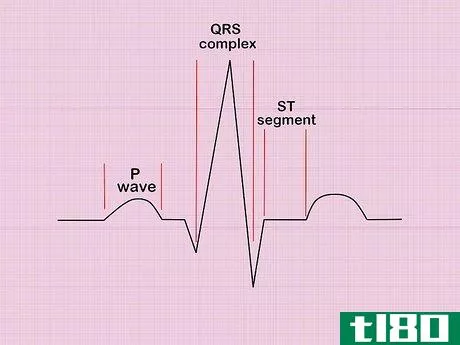 Image titled Calculate Heart Rate from ECG Step 1