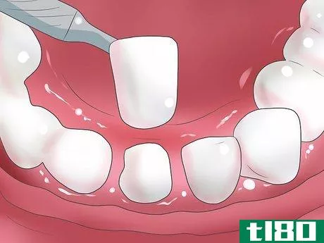 Image titled Bleach Your Teeth Step 12