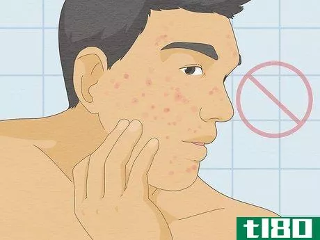 Image titled Be Confident If You Have Acne Step 17