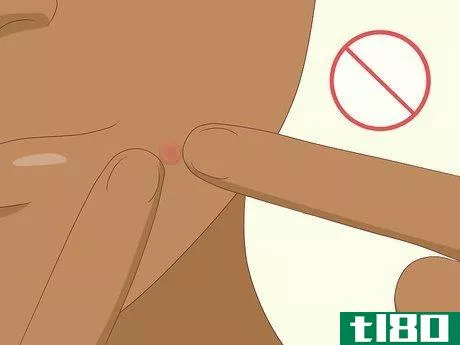 Image titled Avoid Blind Pimples Step 5