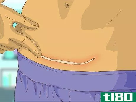 Image titled Care for Your C Section Scar Step 13