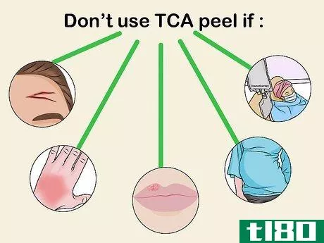 如何涂抹TCA换肤剂(apply a tca peel)