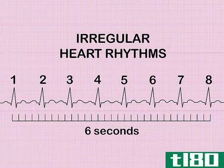Image titled Calculate Heart Rate from ECG Step 8