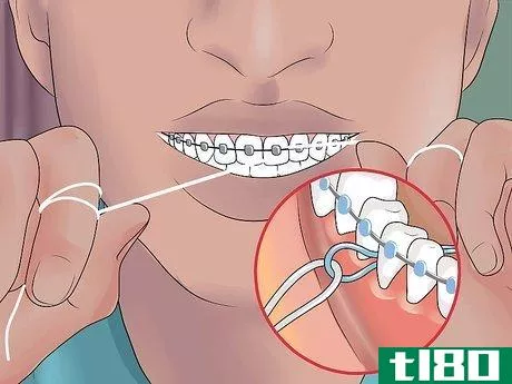 Image titled Be Happy with Braces Step 11