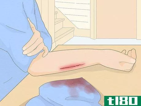 Image titled Bandage a Wound During First Aid Step 4