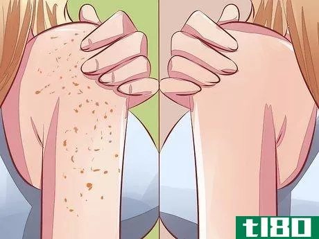 Image titled Avoid Skin Pigmentation During Pregnancy Step 12