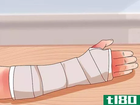 Image titled Apply a Cast to a Broken Arm Step 11