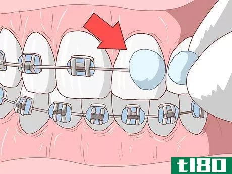 Image titled Avoid Pain When Your Braces Are Tightened Step 13
