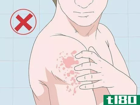 Image titled Avoid Triggers for Chronic Hives Step 14