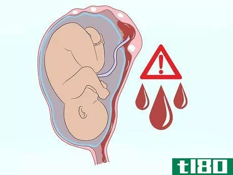 Image titled Deal with Fibroids During Pregnancy Step 9
