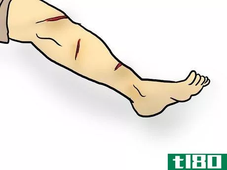 Image titled Complete a Top to Toe Assessment of an Injury Step 13
