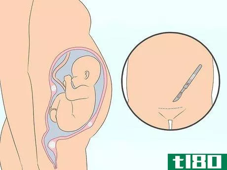 Image titled Deal with Fibroids During Pregnancy Step 4