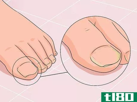 Image titled Cure Nail Fungus Step 1