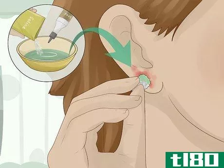 Image titled Clean an Infected Ear Piercing Step 3