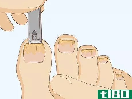 如何治疗脚趾甲真菌：醋有帮助吗？(cure toenail fungus: can vinegar help?)