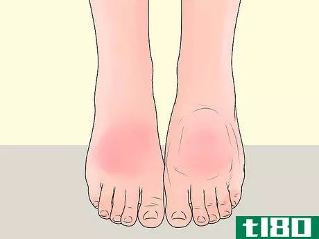 Image titled Check Feet for Complications of Diabetes Step 7