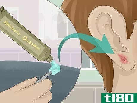 Image titled Clean an Infected Ear Piercing Step 4
