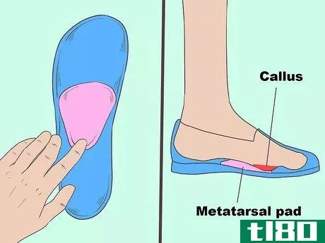 Image titled Cure Metatarsalgia Step 7