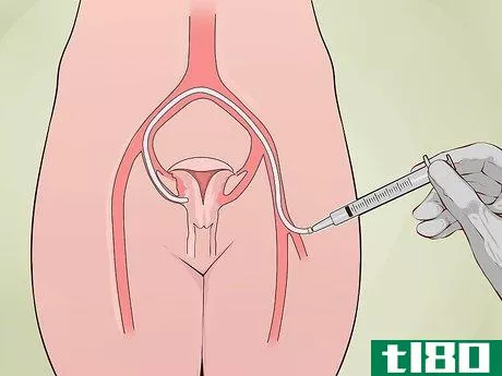 Image titled Decide if You Need a Hysterectomy Step 22