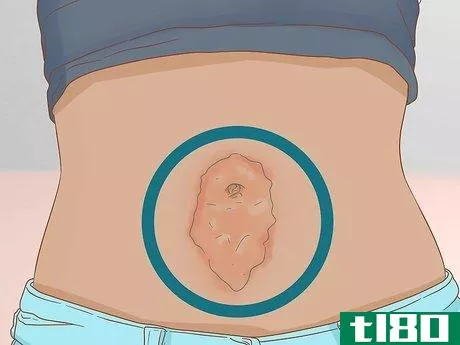 Image titled Clean Your Belly Button Step 6