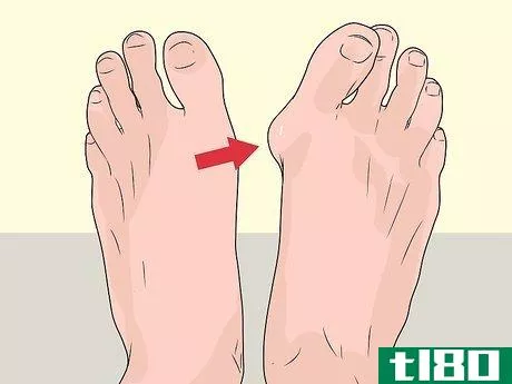 Image titled Check Feet for Complications of Diabetes Step 6
