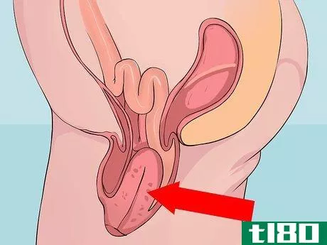 Image titled Decide if You Need a Hysterectomy Step 12