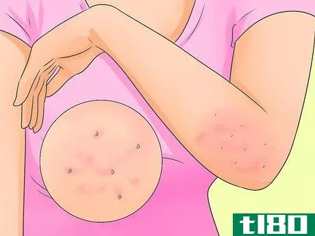 Image titled Cure Scabies Step 1