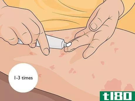 Image titled Control Psoriasis Step 02