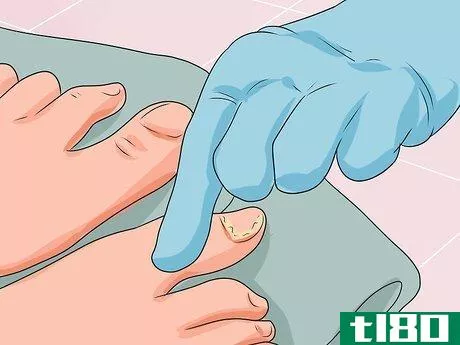 Image titled Cure Nail Fungus Step 4