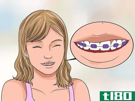 Image titled Choose the Color of Your Braces Step 6