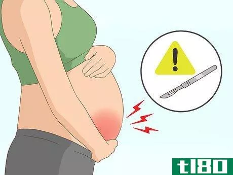 Image titled Deal with Fibroids During Pregnancy Step 5