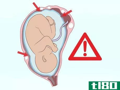 Image titled Deal with Fibroids During Pregnancy Step 8