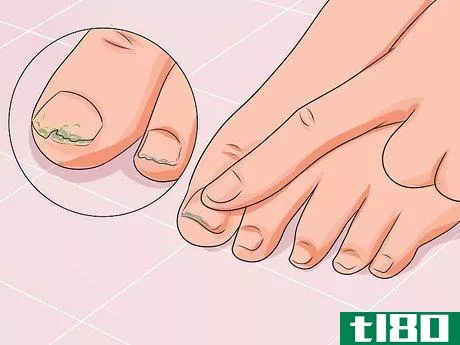 Image titled Cure Nail Fungus Step 3