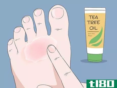 Image titled Cure Athlete's Foot Naturally Step 1