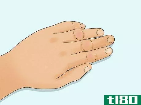 Image titled Diagnose Rheumatoid Arthritis Step 9