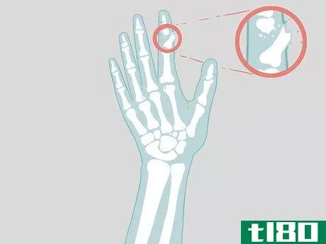Image titled Determine if a Finger Is Broken Step 17