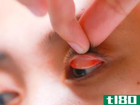 Image titled Flip Eyelids Inside Out Step 9