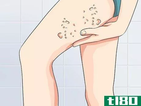 Image titled Ease Herpes Pain with Home Remedies Step 35