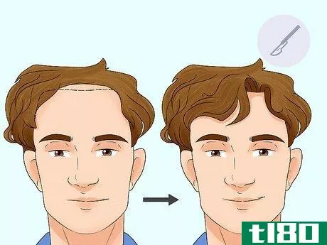 Image titled Fix a Receding Hairline Step 5