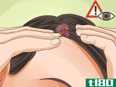 Image titled Diagnose Scalp Psoriasis Step 4