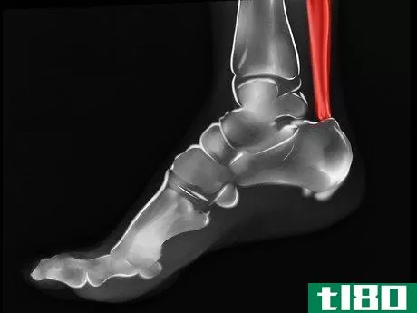 Image titled Diagnose Heel Spurs Step 4