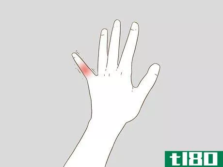 Image titled Determine if a Finger Is Broken Step 3