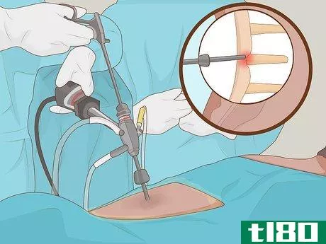 Image titled Diagnose a Herniated Disc Step 20